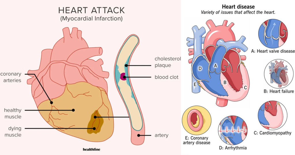 What are the Causes for Heart Diseases?